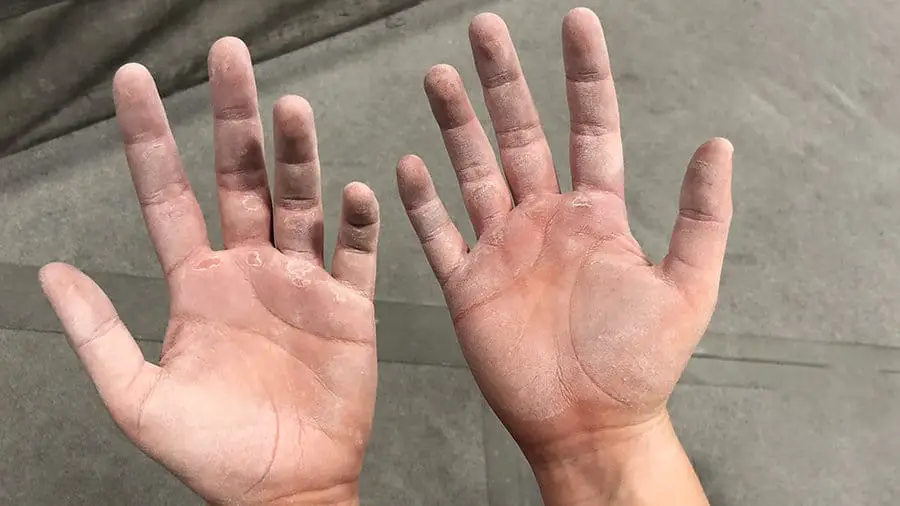 climbers hands injured